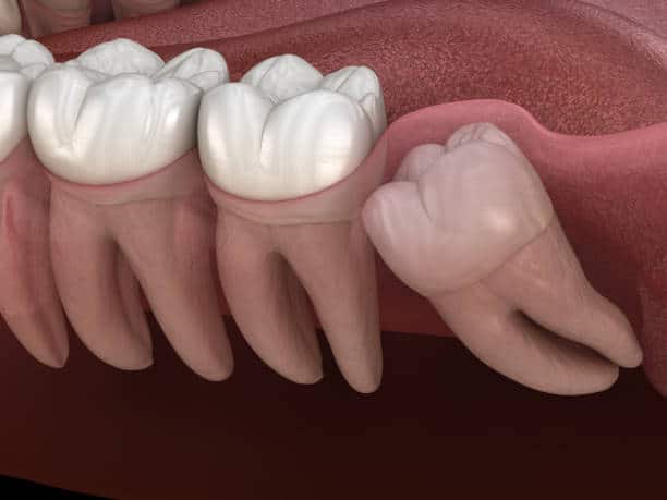 Why Do We Get Dry Sockets and How Do We Treat Them? - All Out Wisdom Teeth